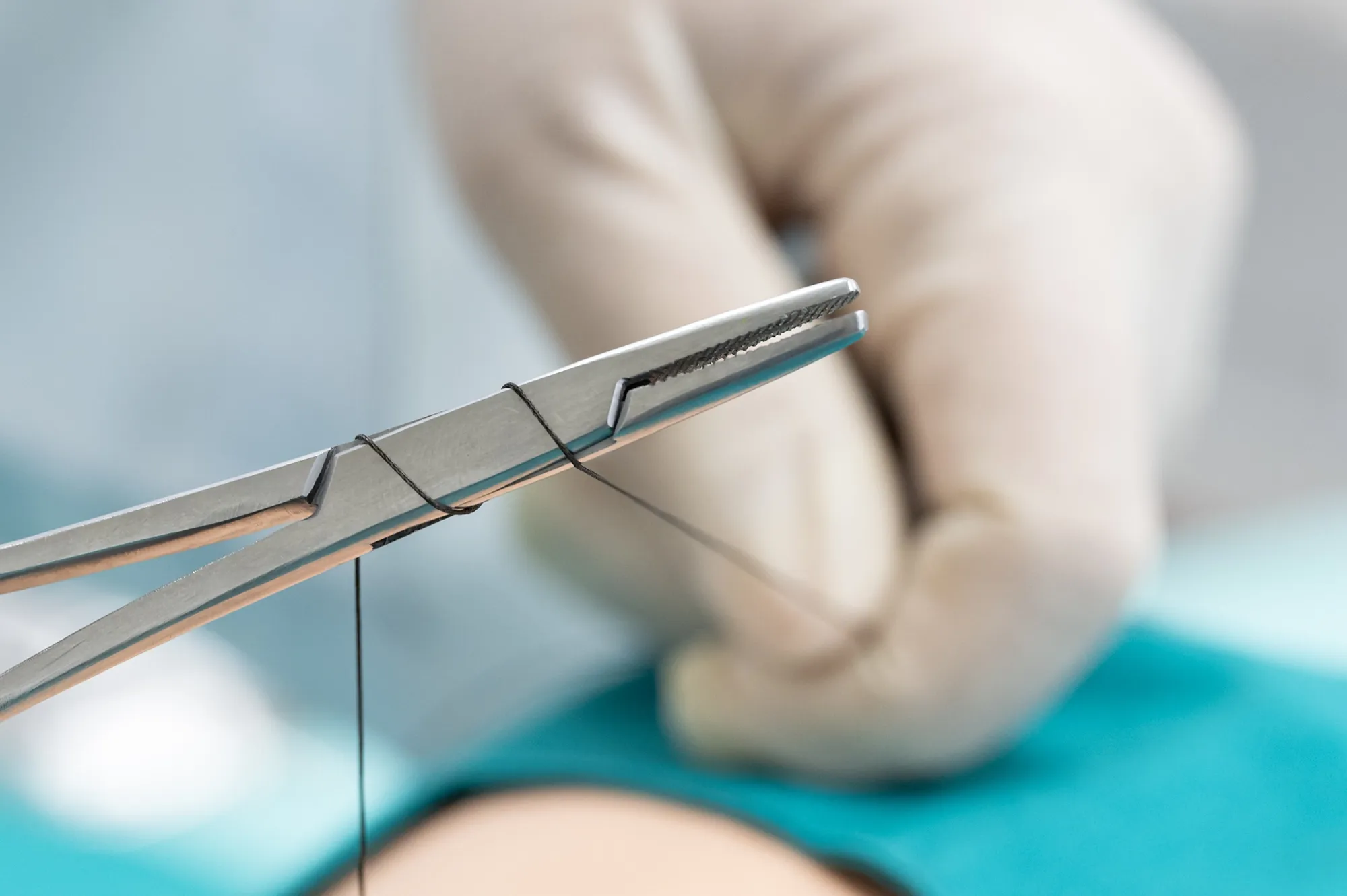 [Esempio] Suture: errori frequenti e come evitarli